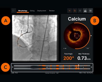 Optical Coherence Tomography (OCT)