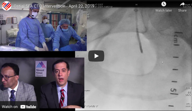 Ostial SFA CTO Intervention