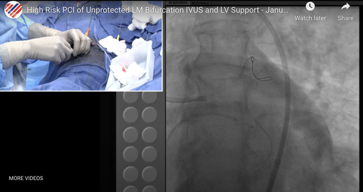 High Risk PCI of Unprotected LM Bifurcation (IVUS and LV Support)