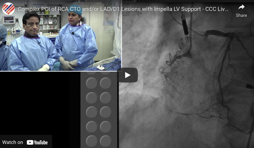 Coronary LV support