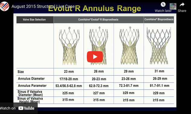 CoreValve Evolut-R TAVR (26mm) via Percutaneous Femoral Access