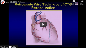PCI of CTO of RCA via Retrograde Approach using LAD Septal Collaterals